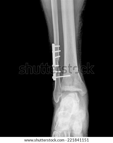 x-ray of a foot with plate and screws seen from the front