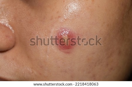 Cystic acne on the face of Southeast Asian man. Large pustule. Royalty-Free Stock Photo #2218418063
