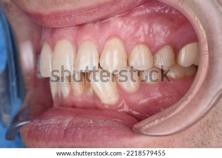 Close up dental problem sick teeth dentist examination before treatment fixator