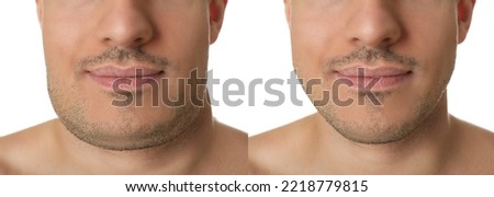 Double chin problem. Collage with photos of man before and after plastic surgery procedure on white background, closeup. Banner design