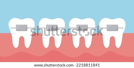 Teeth row with braces. Cute vector teeth with bracket in gum. Cartoon teeth orthodontic treatment.