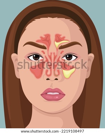Woman With Illustration Of Paranasal Sinus Royalty-Free Stock Photo #2219108497