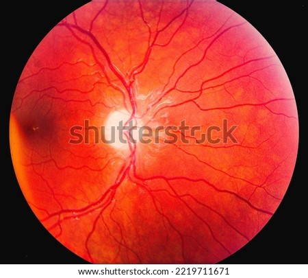 Human eye retinal screening image