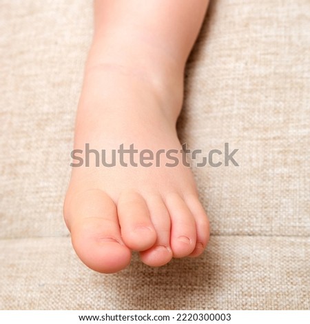 Deformed toes on the foot of the toddler baby, congenital curvature. Kid aged one year and three months Royalty-Free Stock Photo #2220300003