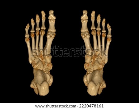 3D rendering  of the foot bones for diagnosis bone fracture and rheumatoid arthritis from CT scannner.
