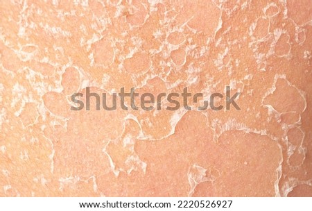 Sunburn, close-up of human skin. Flaky skin from allergies, peeling or eczema. Dry skin in need of treatment and hydration. Royalty-Free Stock Photo #2220526927