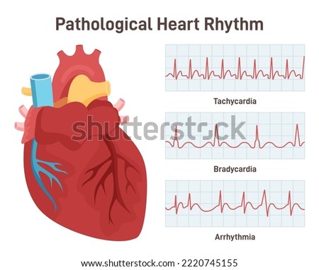 Pathological heart rhythm types. Heart rate graphic or electrocardiogram. Tachycardia, bradycardia and arrhythmia. Flat vector illustration Royalty-Free Stock Photo #2220745155