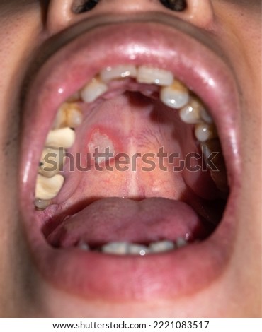 Aphthous ulcer or stress ulcer in mouth of Asian male patient. Royalty-Free Stock Photo #2221083517