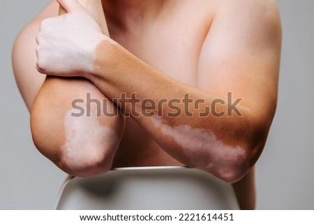 Unrecognizable male vitiligo of hand is part of the face with white patches on the skin. People with skin diseases live like everyone else. It is necessary to accept the natural body for a happy life. Royalty-Free Stock Photo #2221614451