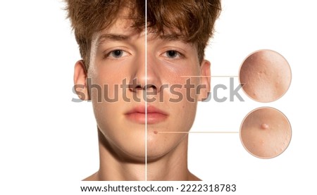 Oily skin problem - acne, blackhead, pustule, papule, enlarged pores. Collage of young man with face skin diseases. Skincare, healthcare, dermatology, medical, beauty. Before after concept