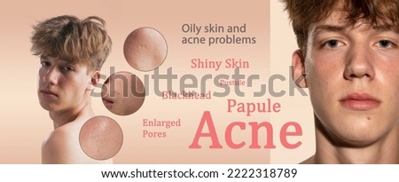 Oily skin and male problem - acne, blackhead, pustule, papule, enlarged pores. Collage with young man and facial diseases. Skincare, healthcare, dermatology, medical, beauty, health concept