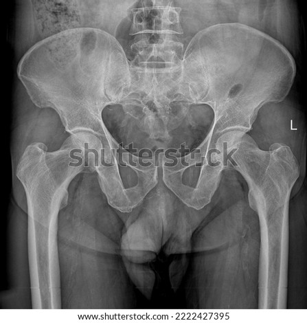 Pelvis X-ray anteroposterior radiograph with left and right proximal femur  Royalty-Free Stock Photo #2222427395