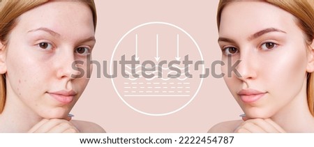Woman before and after lifting skin. Infographic shows deep penetration of remedy in skin. Royalty-Free Stock Photo #2222454787