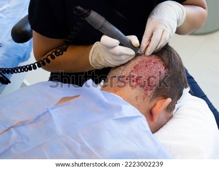 patient during the graft extraction with the motor, from the donor zone Royalty-Free Stock Photo #2223002239