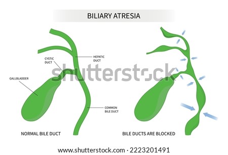 BILIARY-ATRESIA Stock Vector Images - Avopix.com