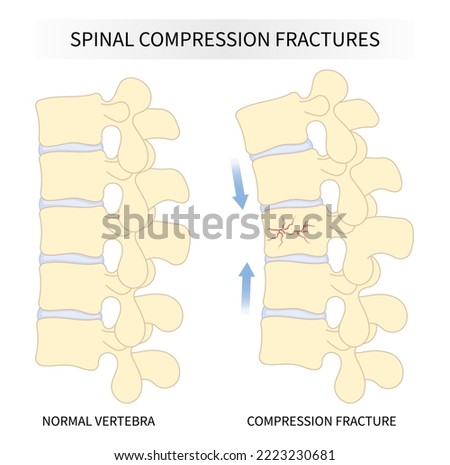 backbone vertebral column joint disease with kyphoplasty spine of dowager’s hump posture hunched back over bone disk neck pain surgical degeneration Royalty-Free Stock Photo #2223230681