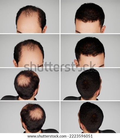 3D Render and 3D illustration Man before after hair loss treatment. Head balding man before after hair.  Royalty-Free Stock Photo #2223596051