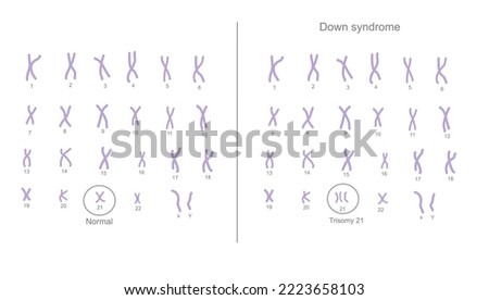 The chromosome 21 are changed the copy number from normal (2 copies) to abnormal (extra) chromosome (3 copies) that call Trisomy 21: Down syndrome Royalty-Free Stock Photo #2223658103