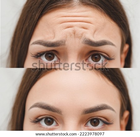 The skin of a woman's face before and after cosmetic procedures of aesthetic beauty with the removal of skin wrinkles. injections in the forehead Royalty-Free Stock Photo #2223978097
