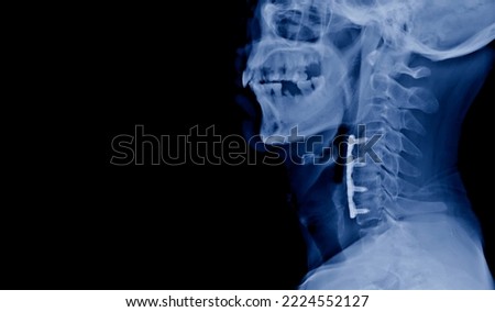 Lateral projection cervical spine x-ray showing anterior cervical discectomy and fusion or ACDF procedure. The patient has spinal cord compression and myelopathy due cervical spondylosis. Royalty-Free Stock Photo #2224552127