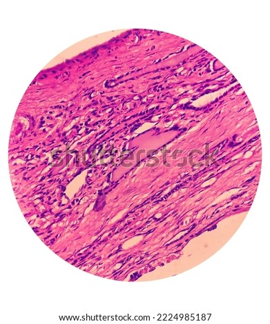 Thyroid cancer: Microscopic image of Follicular variant of papillary carcinoma. Malignant neoplasm of atypical thyroid follicular epithelial cells. Nodular goiter. Royalty-Free Stock Photo #2224985187