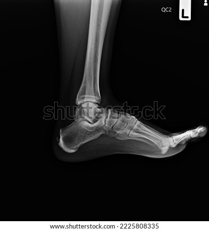 film  x-ray show ankle joint