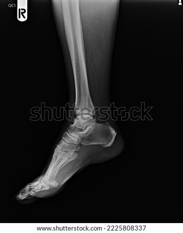 film  x-ray show ankle joint