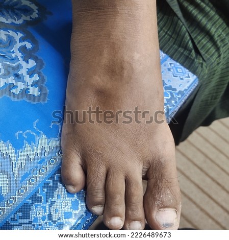 An Asian old man came to the clinic with foot oedema. Oedema may be due to liver failure, renal failure, heart failure, angioneurotic oedema. Royalty-Free Stock Photo #2226489673