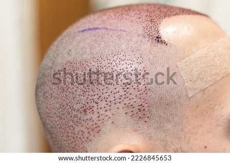 Baldness cure. Treatment for hair loss. Side view of male scalp after hair transplant surgery Royalty-Free Stock Photo #2226845653