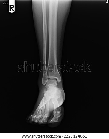 film x ray fracture of broken ankle