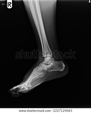 film x ray fracture of broken ankle