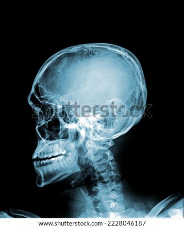x-ray Skull show normal human's skull