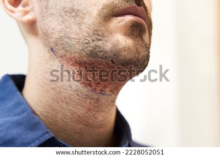 Male beard after hair transplant surgery Royalty-Free Stock Photo #2228052051