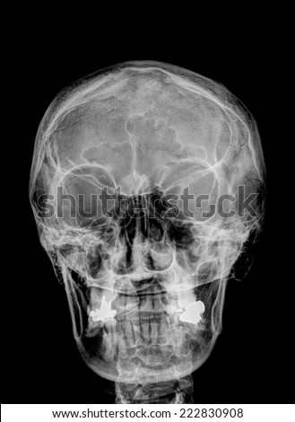 X-ray of the skull of the head