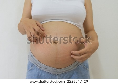 Pregnant woman scratching belly because itchy skin which causes striped, Pregnancy medicine concept. Royalty-Free Stock Photo #2228347429