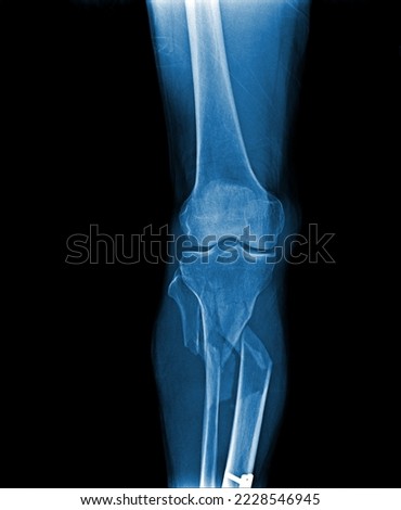  film x-ray AP  of knee and leg show fracture