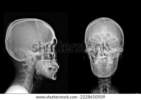 X-ray Lateral view skull and cervical spine . AP skull and cervical spine Royalty-Free Stock Photo #2228650509