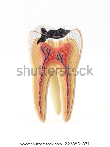 Isolated photo of internal tooth structure model with caries destruction on white background Royalty-Free Stock Photo #2228951871