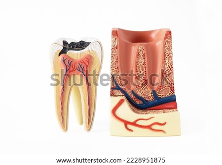 Isolated on a white background educational model of a tooth with caries in a section with channels and vessels. Dental care concept. Royalty-Free Stock Photo #2228951875
