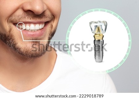 Man with beautiful smile after dental implant installation procedure on grey background, closeup Royalty-Free Stock Photo #2229018789
