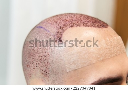 End to baldness concept. Male scalp after hair implant surgery Royalty-Free Stock Photo #2229349841
