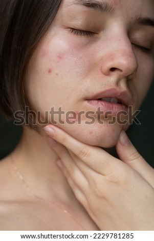 the problem of acne pimples on the chin. facial skin care. combination skin
 Royalty-Free Stock Photo #2229781285