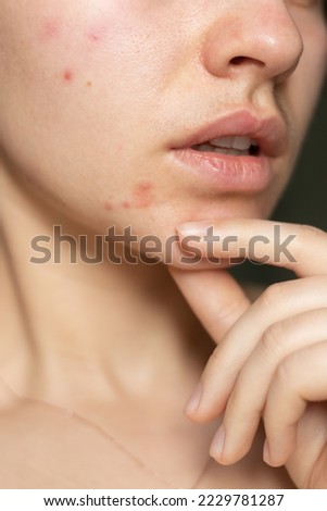 the problem of acne pimples on the chin. facial skin care. combination skin
 Royalty-Free Stock Photo #2229781287