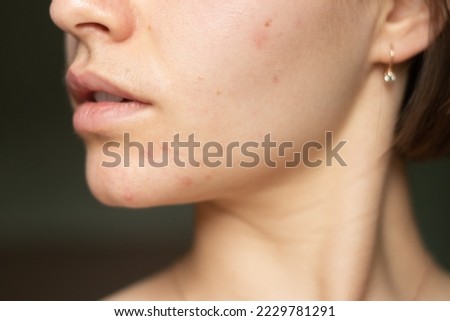 the problem of acne pimples on the chin. facial skin care. combination skin
 Royalty-Free Stock Photo #2229781291