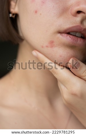 the problem of acne pimples on the chin. facial skin care. combination skin
 Royalty-Free Stock Photo #2229781295