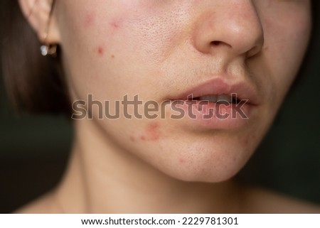 the problem of acne pimples on the chin. facial skin care. combination skin
 Royalty-Free Stock Photo #2229781301