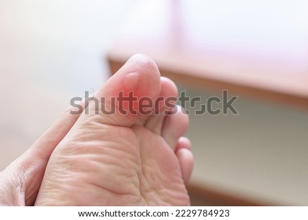 man having bunion toes or blister due to wearing narrow shoes and waking or running longtime, barefoot pain due to Plantar fasciitis. Health and medical concept Royalty-Free Stock Photo #2229784923
