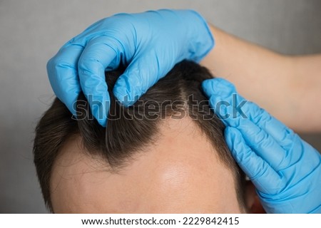 Hands of doctor in rubber gloves doing checkup of hair of man to fight male-pattern baldness. Patient gets prepared for hair transplant surgery closeup Royalty-Free Stock Photo #2229842415