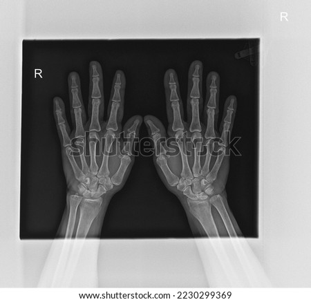 X-ray of the hands. Real x-ray picture of a hands with fingers
