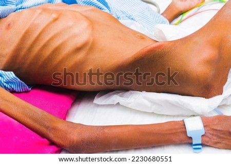 A picture of a human body with severe emaciation, bony prominence and skin changes due to malnutrition Royalty-Free Stock Photo #2230680551